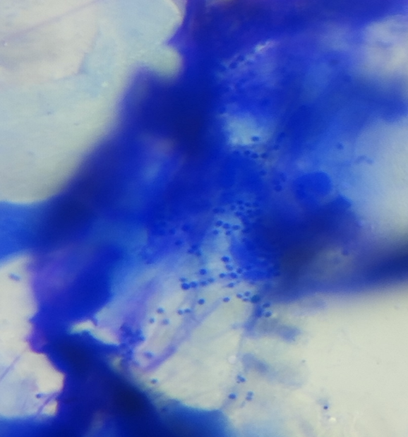 Фото 10. Цитологическое исследование материала, полученного из НСП: присутствуют бактерии-кокки.