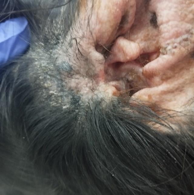 Фото 3. Хронический наружный отит с характерными изменениями кожи ушной раковины: лихенификация, гиперпигментация, шелушение.