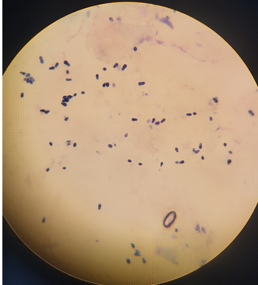 Фото 12. Цитологическое исследование материала, полученного из НСП: присутствуют дрожжевые грибы (Malassezia).