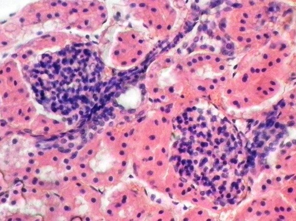 Пролиферация и гипертрофия клеток нефротелия (париетального листка капсулы Боумена) – клеточные депозиты («полулуния») в капсуле Боумена