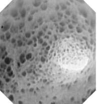 Внешний вид слизистой оболочки двенадцатиперстной кишки при эндоскопическом исследовании