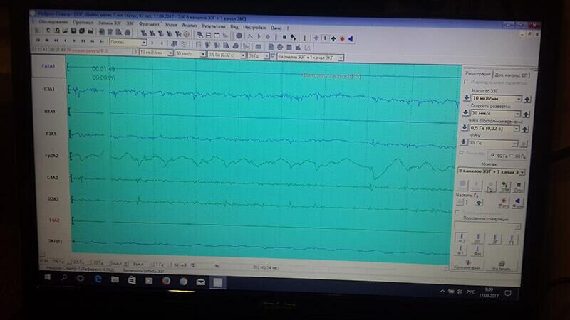 ЭЭГ Блэка. Продленное мониторирование