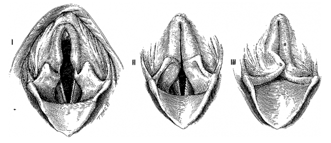 нормальная гортань, паралич гортани, коллапс гортани
