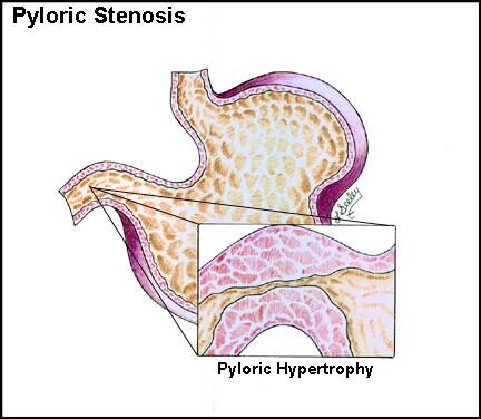 Гипертрофический гастрит и пилорическая гипертрофия слизистой