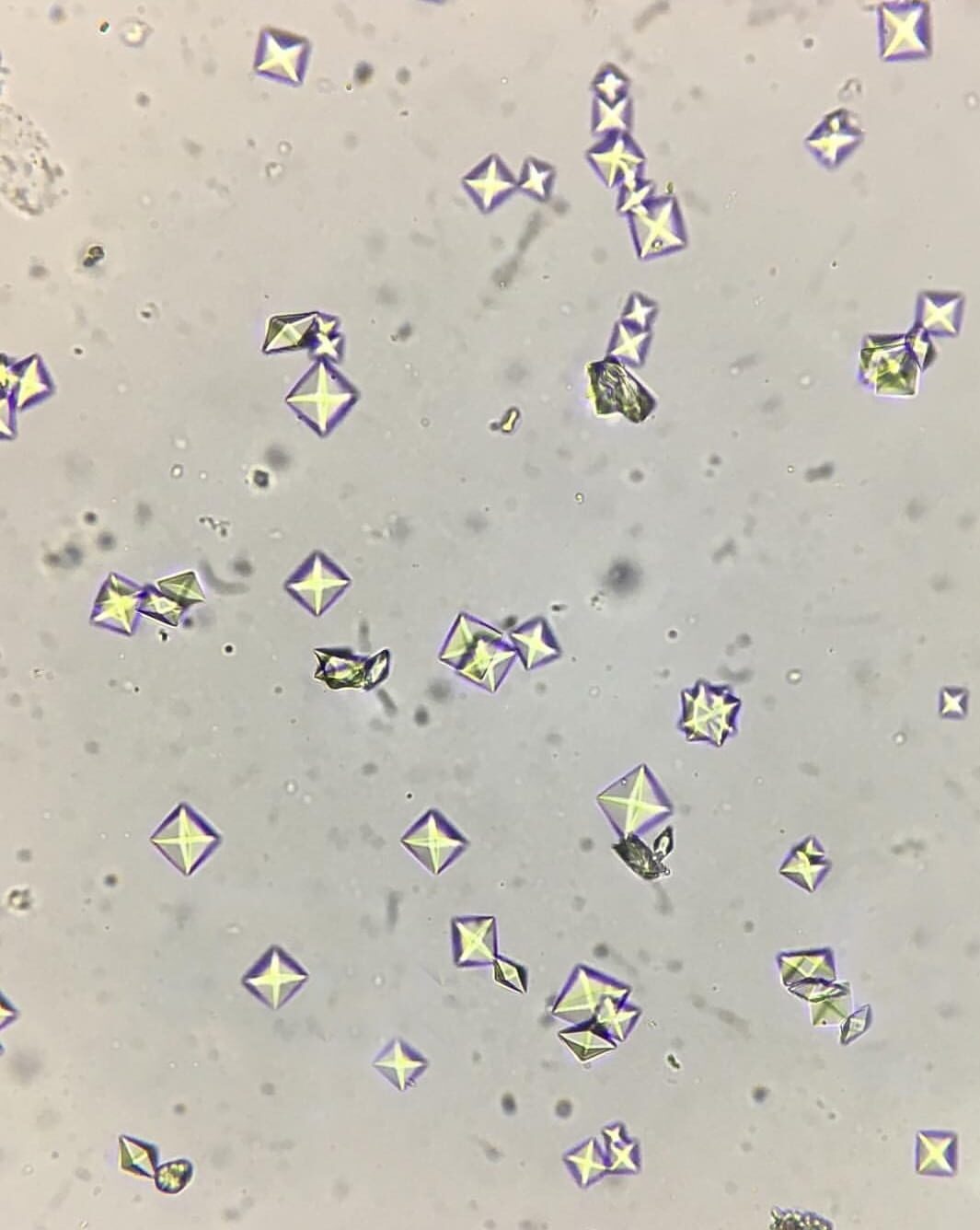 При микроскопии осадка мочи обнаружены оксалаты кальция